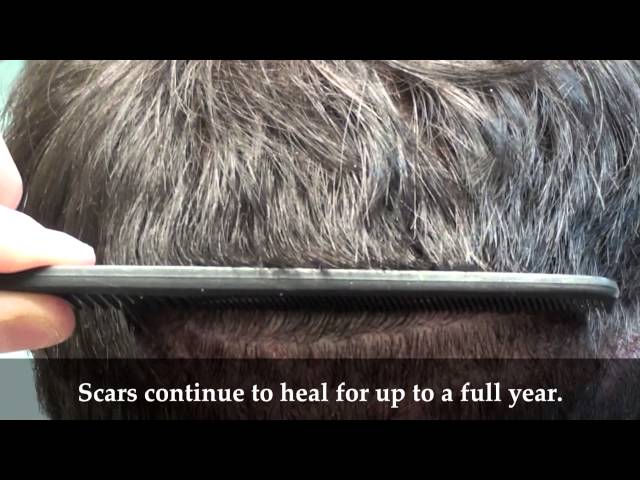 Patient 14 Undetectable Scar: 10 Days