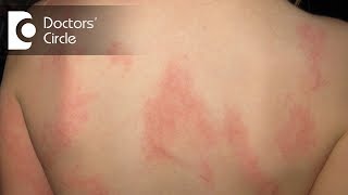 What happens in Hives and Angioedema? - Dr. Nischal K