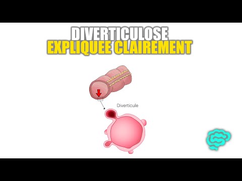 🔴 La Diverticulose Expliquée Très Clairement par Dr Astuce