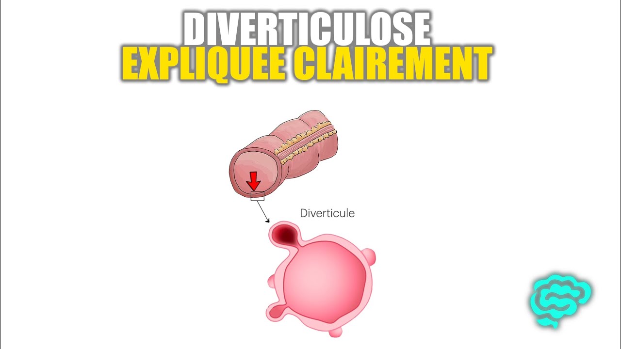 🔴 La Diverticulose Expliquée Très Clairement par Dr Astuce