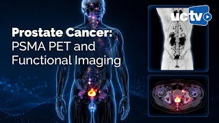 Prostate Cancer: PSMA PET and Functional Imaging