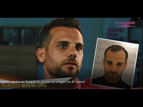 Agustín: su injerto capilar en Estepera Turquía le cambió la imagen — resultado real
