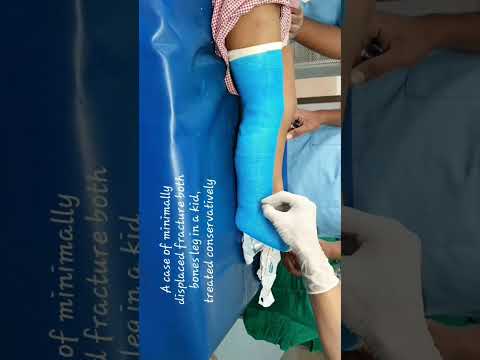 Fiberglass plastering | Plastering tips in fractures | PAEDIATRIC frctrs, Closed reduction | Adamya