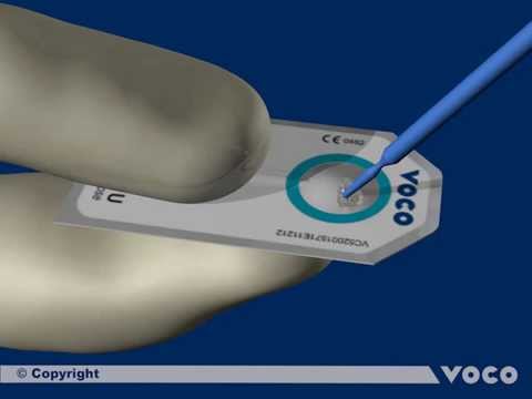 Universal adhesive Futurabond U-Part 1/12: Preparing the SingleDose