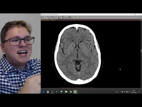 COMO AVALIAR UMA TOMOGRAFIA DO CRÂNIO? | LIVE DE TC #3