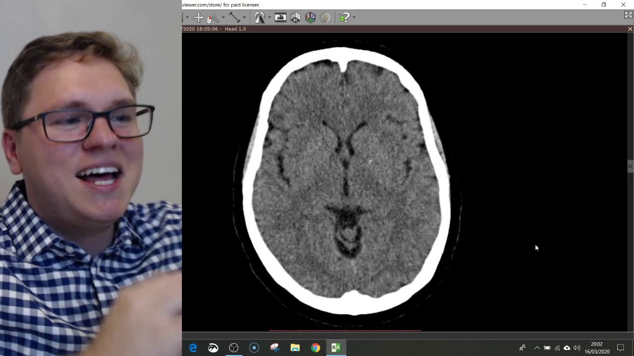 COMO AVALIAR UMA TOMOGRAFIA DO CRÂNIO? | LIVE DE TC #3