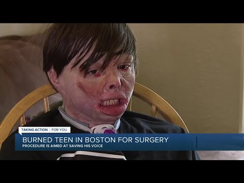 Burned teen in Boston for surgery