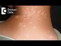 What are different types of white patches? - Dr. Vivekanand Bhat