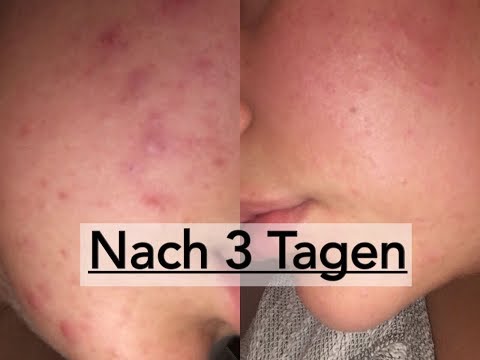 Für Gelenke der Pferde Menschen Nach der Reduktion des Gelenks