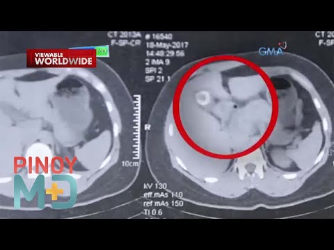 Pagkakaroon ng gallstones o bato sa apdo, paano maiiwasan? | Pinoy MD