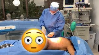 MY BBL EXPERIENCE: SURGERY DAY!!