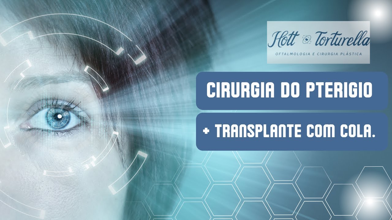 Cirurgia de pterígio com autotransplante conjuntival sem pontos — Dr. Vitor Torturella RJ