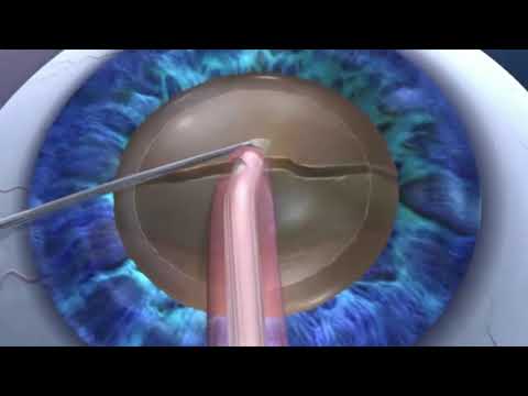 Laser Assisted Cataract Surgery at Vision Mendez.