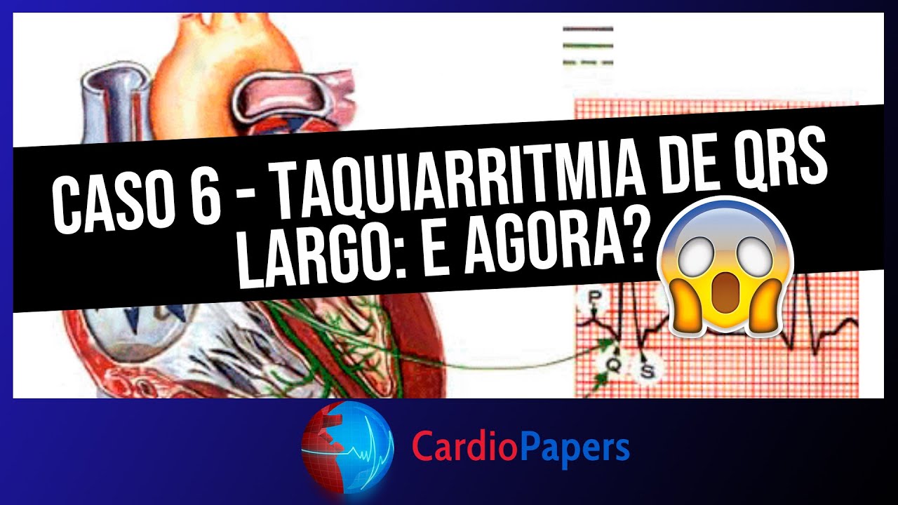 Taquicardia QRS Largo: saiba como identificar no ECG!