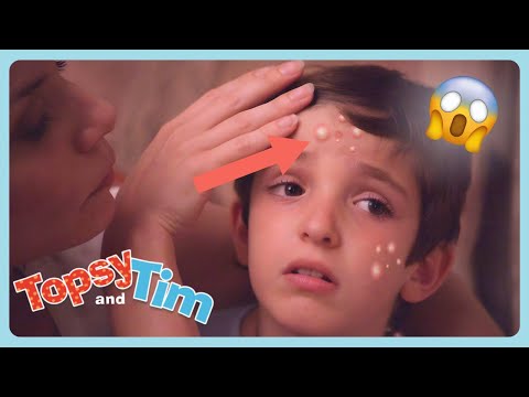 CHICKEN POX! 🤒🙁 | Topsy & Tim Full Episode Compilation For Kids | WildBrain Zigzag