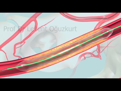 Anjiyo yöntemiyle balon ve stent kullanarak tıkalı damarı açmak