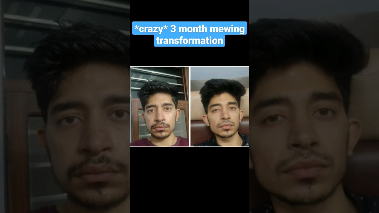 *CRAZY* 3 Months of mewing !