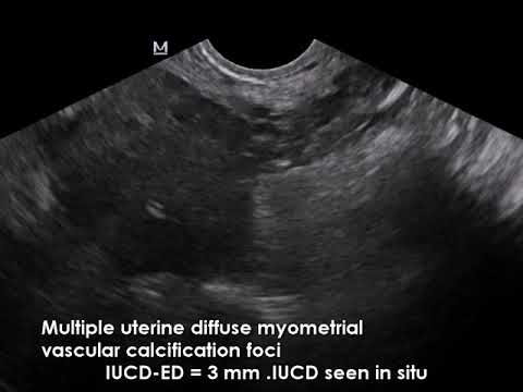 myometrium visszér)