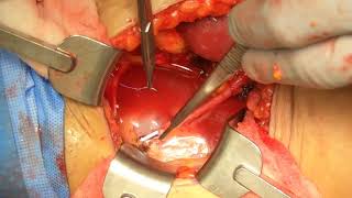 Core Videos (2024): Lich-Gregoir Ureteroneocystostomy