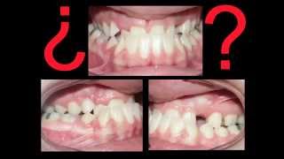 Clase III. Prognacia Mandibular. Mandíbula Grande Adelantada. Sin Cirugía