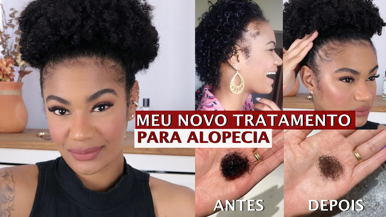 NOVO TRATAMENTO PARA ALOPECIA + COMO PAREI MINHA QUEDA DE CABELO •  Patt Neves