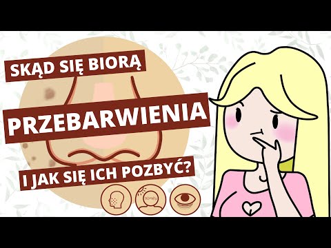 Rozjaśnianie przebarwień i blizn po trądziku - porady i kosmetyki