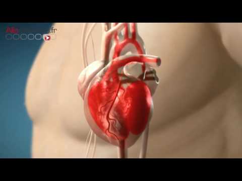 Maison à abaisser la pression artérielle Lhypertension chez les prématurés
