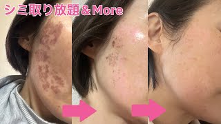５０代ぼっち主婦がシミ取りした結果【銀座】