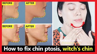 How to fix chin ptosis, witch