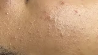 Relaxing Acne Cleansing with LinhMyDang  #593