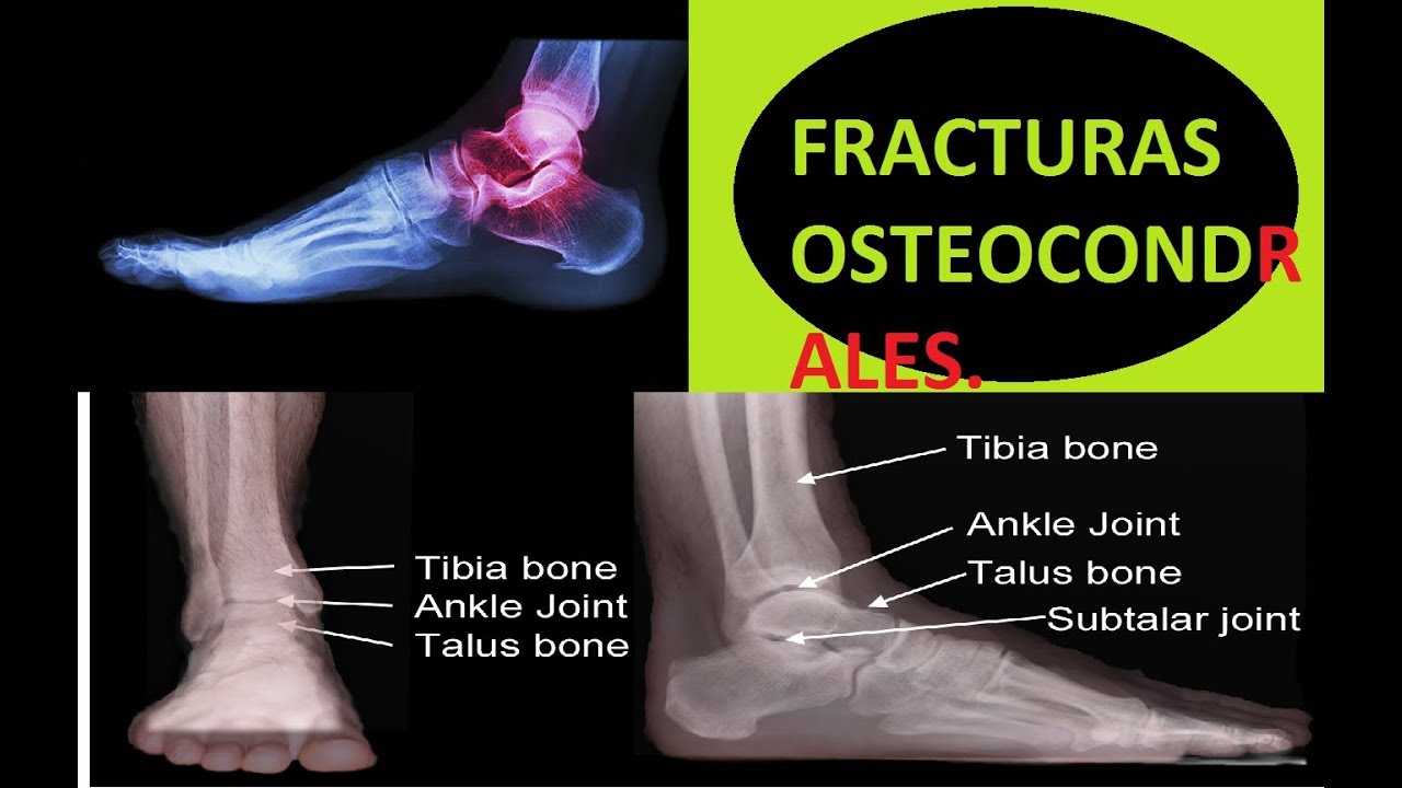 Watch lesiones osteocondrales (fracturas tobillo) / Terapia en casa Now lesiones osteocondrales (fracturas tobillo) / Terapia en casa