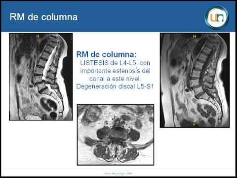 Neuronavegador 3D: Ayuda a la implantación de tornillos transpediculares