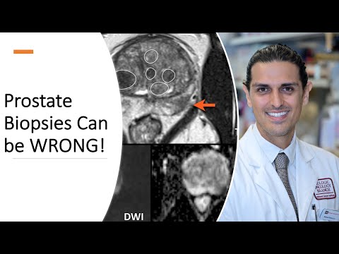 Prostate Biopsies Can Be WRONG! -  Dr. Ahdoot Explains Prostate Cancer Diagnosis