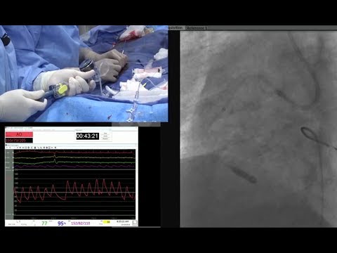 (20 min CCC Dec '18) - Complex PCI of a Severely Tortuous Ectatic RCA