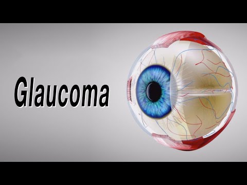 Glaukom (Animation, warum es passiert und wie es Blindheit verursachen kann)