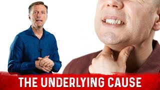 Burning Throat Syndrome or Silent Acid Reflux Causes – Dr.Berg