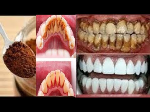 Coffee spoon to whiten teeth and remove dental  tartar in 3 minutes at home, without a doctor