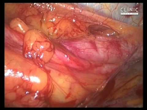 Transvaginal Nephrectomy In Laparoscopy