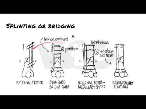 Principles of Fracture Fixation | Orthopedic Basics