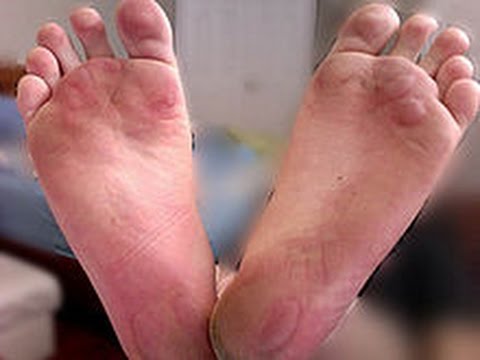 Pasalingsing kuko paggamot Halamang-singaw kuko sa paa kuko Lotseril presyo