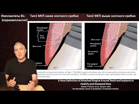 Мягкотканная интеграция имплантата (часть 6) Прикрепленная десна