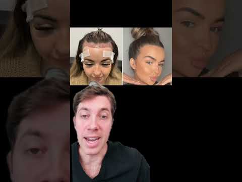 Transform Your Hairline with a Female Hair Transplant