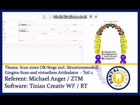 EXOCAD TUTORIAL - Teaser -  Scan eines OK-Stegs incl. Situ / Gingiva-Scan + virt. Arti. Teil 2