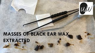 532 - Masses of Black Ear Wax Extracted | The Wax Whisperer