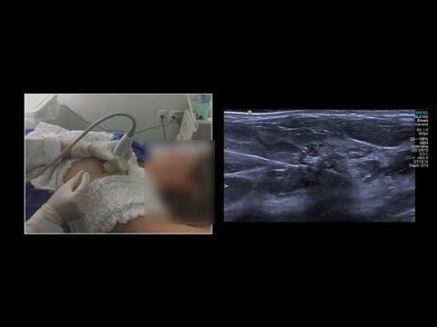 Agulhamento ecográfico de nódulos mamários