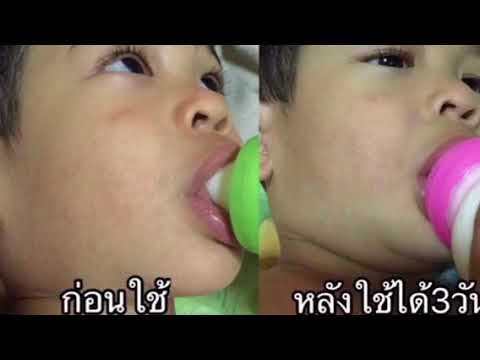 โรคสะเก็ดเงินมีเลือดออกทางผิวหนัง กลากรอบดวงตา