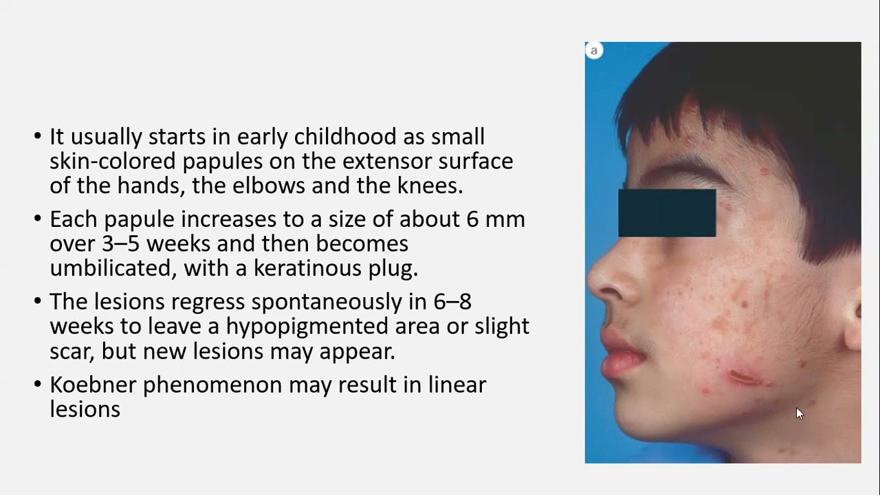 Lecture-149: Perforating Dermatoses. Rook's Chapter 96. - YouTube