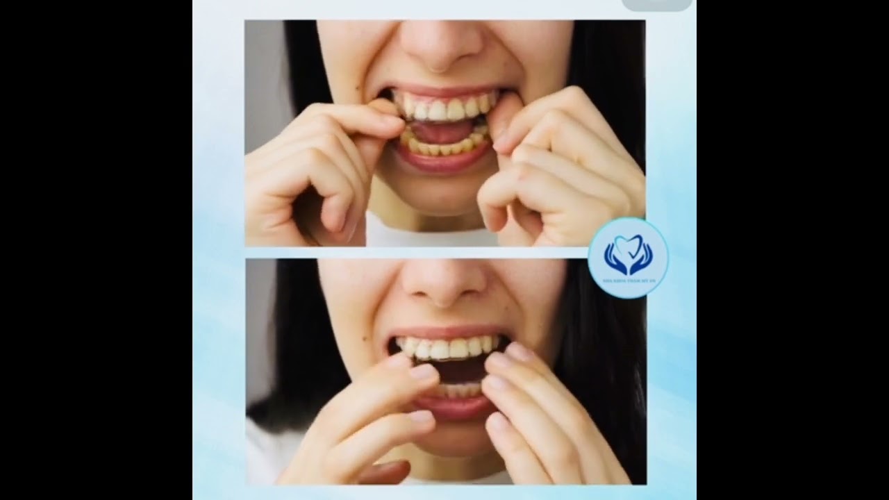 Chỉnh nha chưa bao giờ dễ đến thế - Nha khoa uy tín quận 3