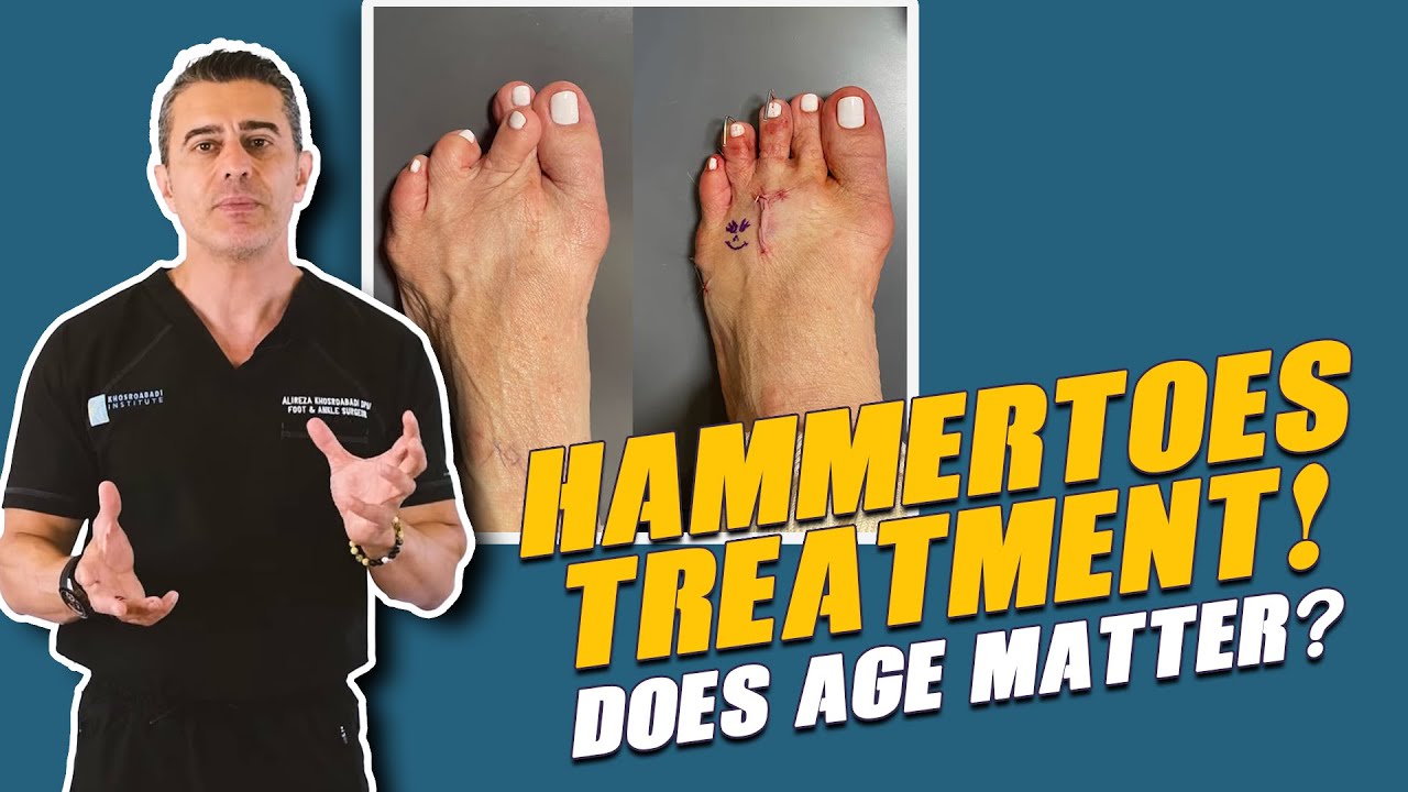 Hammertoe Treatment! Does age matter? | YouTube Shorts
