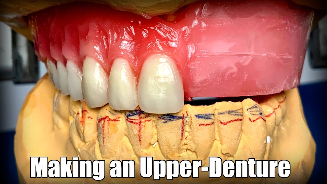 Making an Upper-Denture